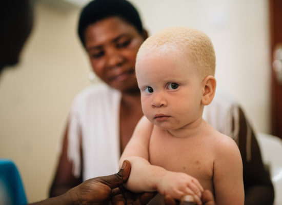 Dermatologie en milieu tropical: consultation d'une enfant atteinte d'albinisme dans la cadre d'un programme de prévention des cancers de la peau en Tanzanie.